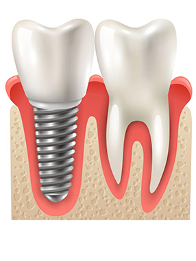 dental implants