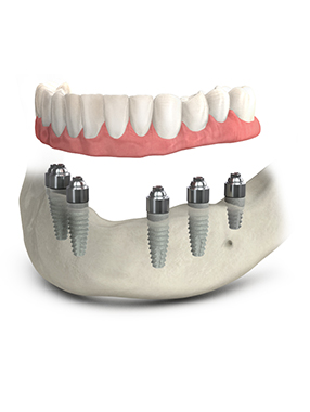 full mouth reconstruction