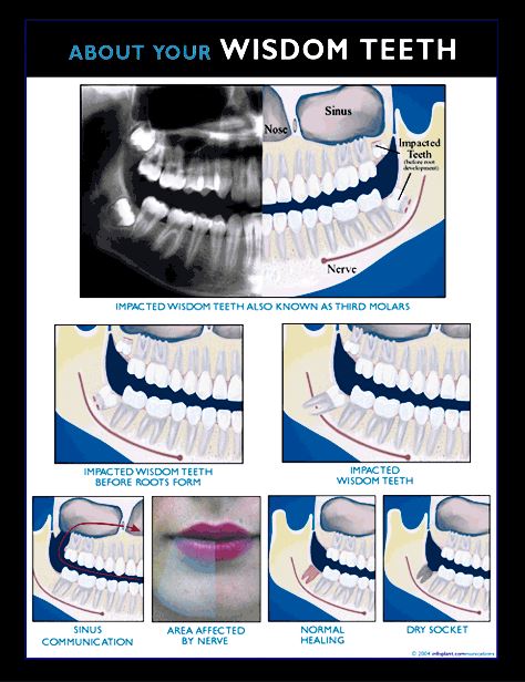 wisdom teeth before and after